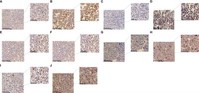The immune checkpoint expression in the tumor immune microenvironment of DLBCL: Clinicopathologic features and prognosis